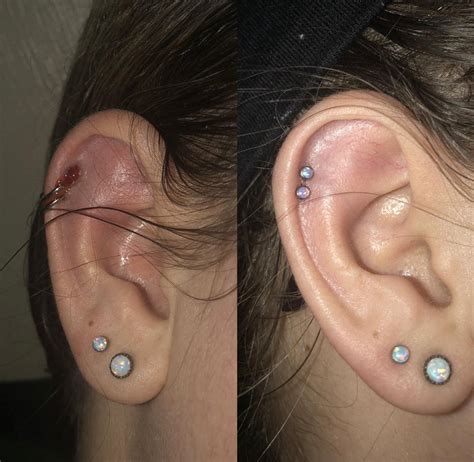 cartilage piercing blister